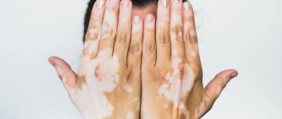 vitiligo a cukorbetegség kezelésének)