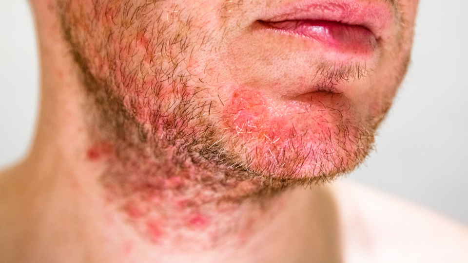 Szeborreás dermatitis