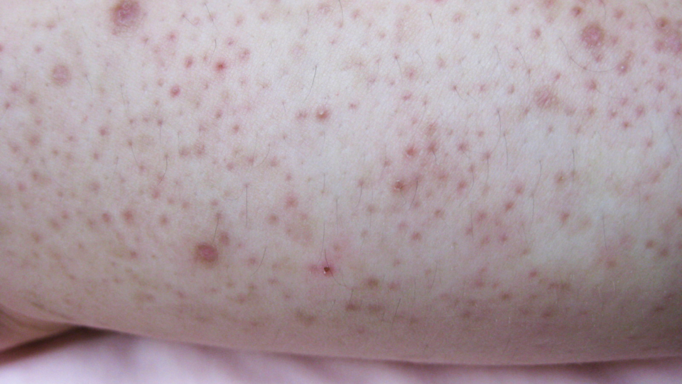 Keratosis pilaris