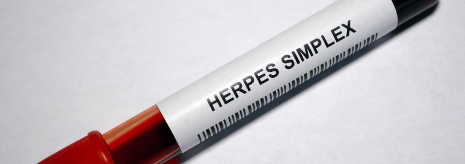 Herpes simplex