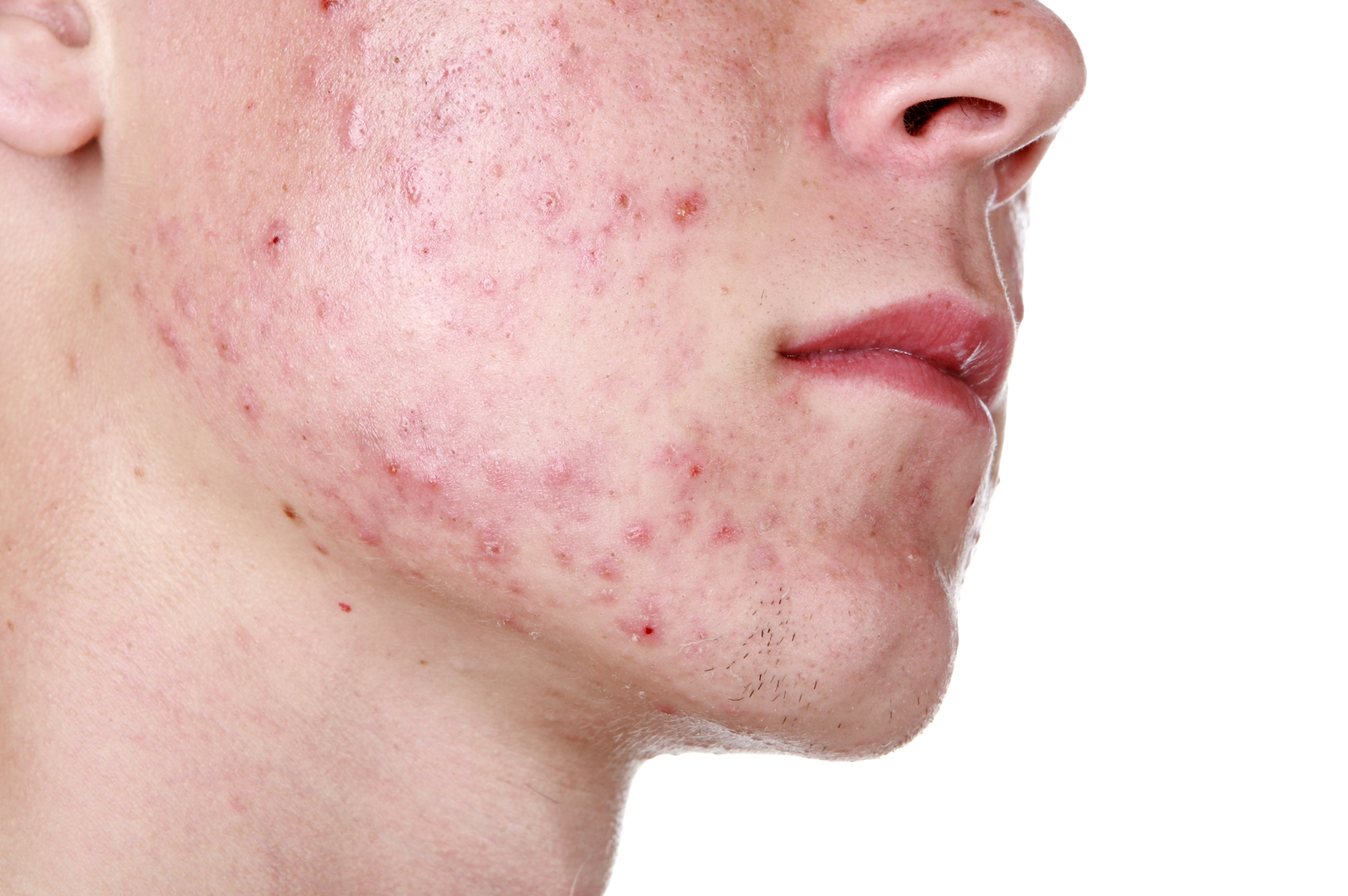 Minden amit az arcbőr kipirosodásáról tudni kell | BIODERMA