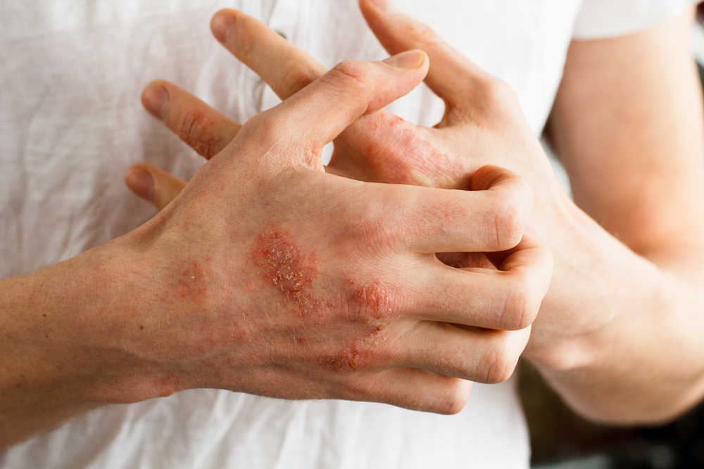 Vörös pikkelyes foltok jelennek meg a bőrön A bőr elszíneződése nem maga betegség, csak tünet