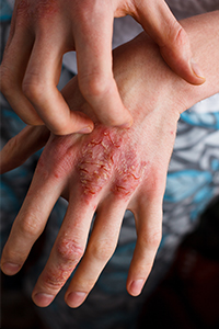 száraz ekcéma kezelése házilag egy álomban vörös foltok vannak a kezeken