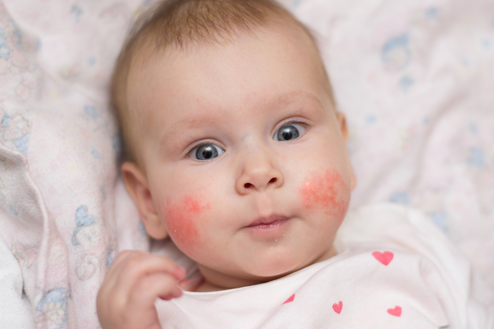 Az atópiás dermatitisz sokszor már gyermekkortól kezelendő.