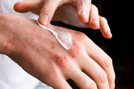 A z ekcéma kezelése bőrgyógyászati módszerekkel és stresszoldással is elérhető.