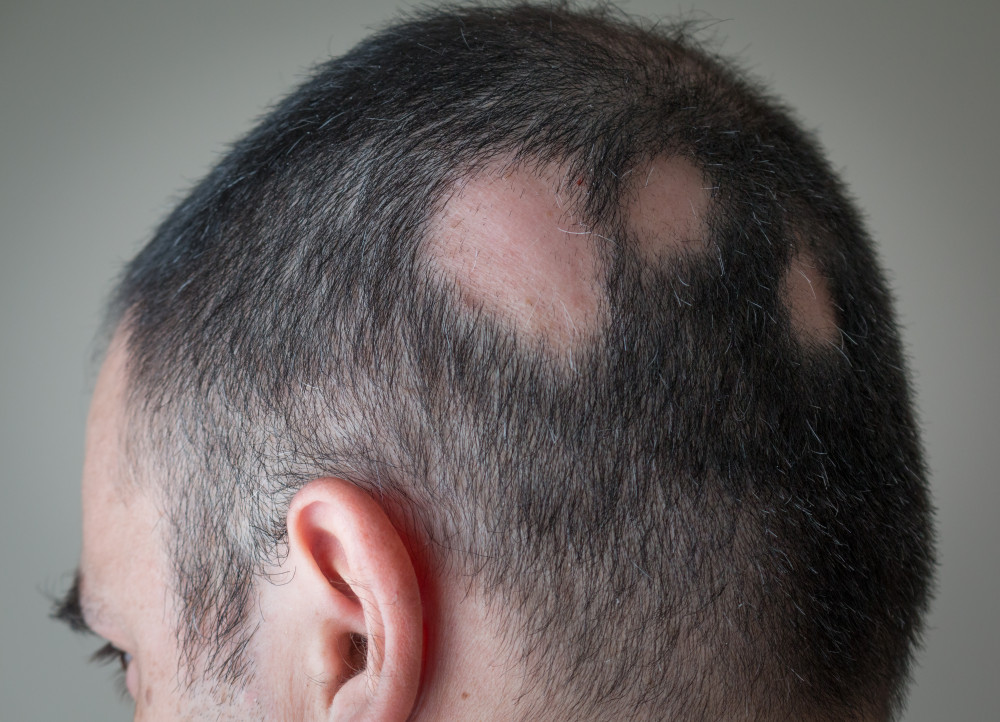 A foltos hajhullás a szőrtüszőket érintő, autoimmun betegség.