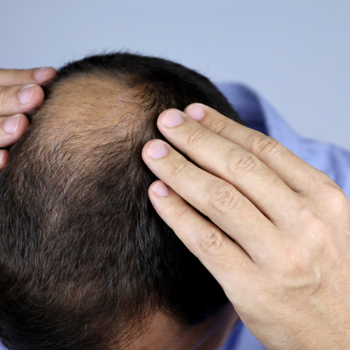 Sokféle kezelési lehetőség segíthet a hajhulláson.