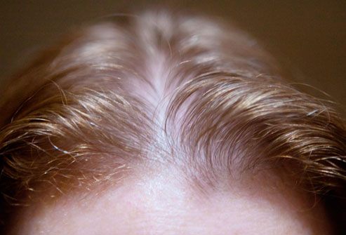 A hajhullás lehet a viszkető, seborreás fejbőr következménye is.