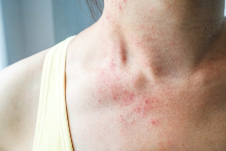 A szteroid okozta pattanás bőrgyógyász segítségével kezelhető.