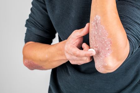 A psoriasis állapota összefügg az immunrendszerrel. 