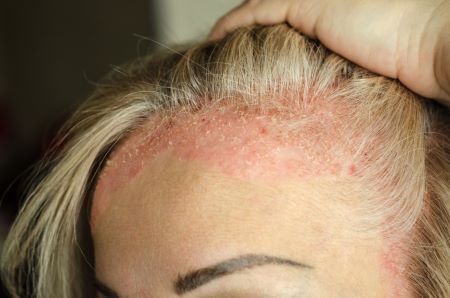 A hajhullás oka pikkelysömör, gomba és seborrheás dermatitisz is lehet.