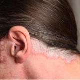 Megkülönböztetni a pikkelysömör és a seborrhoeás dermatitis
