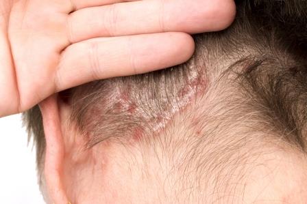 seborrhoeás dermatitis hajas fejbőrön pikkelysömör tünetei kezelés prognózisa