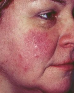 Milyen betegségre utalnak a vörös foltok?, Karcos arc vörös folt viszketés