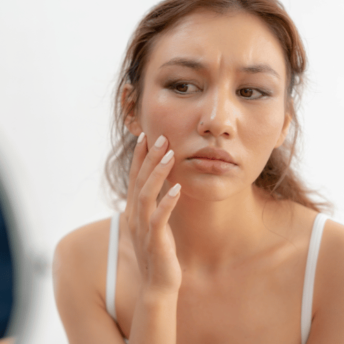 rosacea
