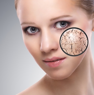 Az arcbőr szárazságát olyan betegségek is okozhatják, mint az ekcéma. 