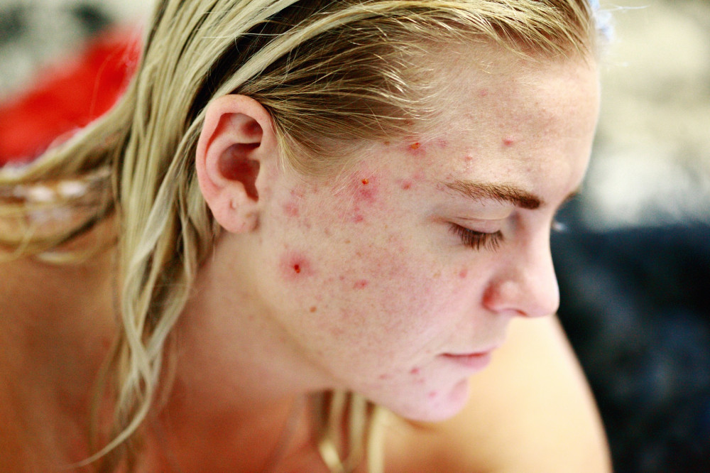 pattanásos bőr kozmetikai kezelése - Dermatica Kozmetika