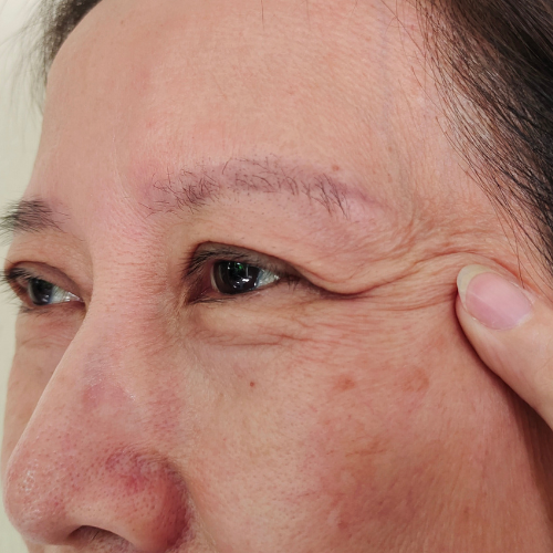 Megereszkedett szemhéj műtéti kezelése