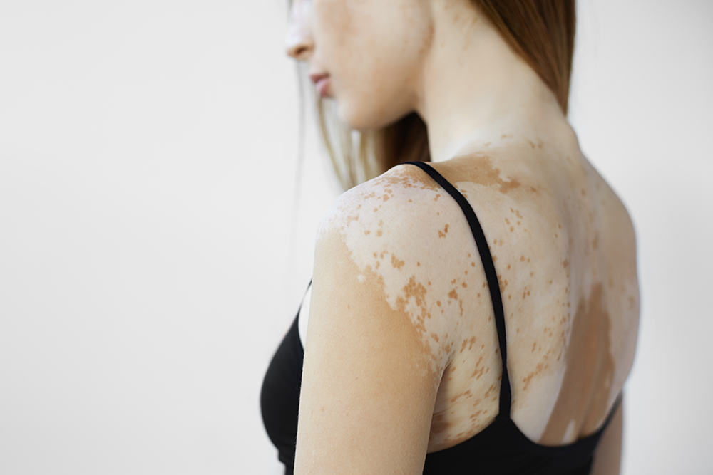 A vitiligó, vagy fehérfoltos pigmenthiány test szerte előfordulhat.