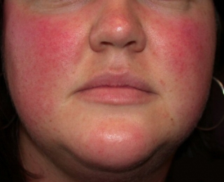 Rosacea: mit tehetsz a piros, gyulladt foltok ellen?