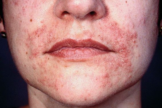 bőrbetegségek az arcon)