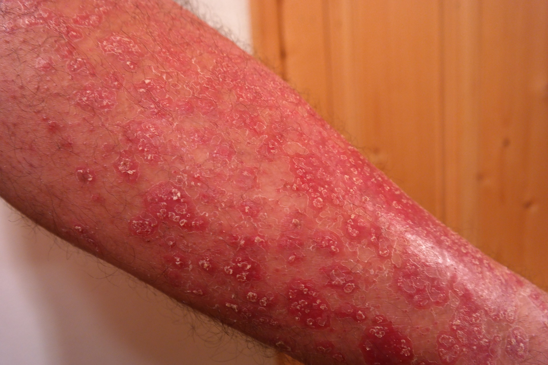 online pikkelysömör kezelése a bőrnek vörös foltja van és viszket