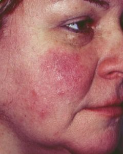 Pikkelysömör (pszoriázis, psoriasis) tünetei és kezelése - HáziPatika