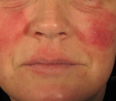 rosacea pikkelysömör kezelése