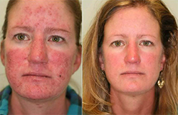 rosacea rádiofrekvenciás kezelése Dermatica bőrsebészet