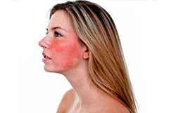 rosacea rádiofrekvenciás kezelése Dermatica bőrsebészet