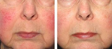 rosacea rádiofrekvenciás kezelése Dermatica bőrsebészet