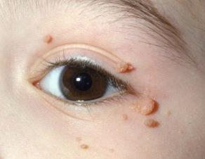 szemölcs vagy a bőr vírusos fertőzése papillomavírus-kórokozó felelős
